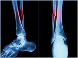 Bone Fracture Injury on Fibula from a car accident in Topeka, Kansas