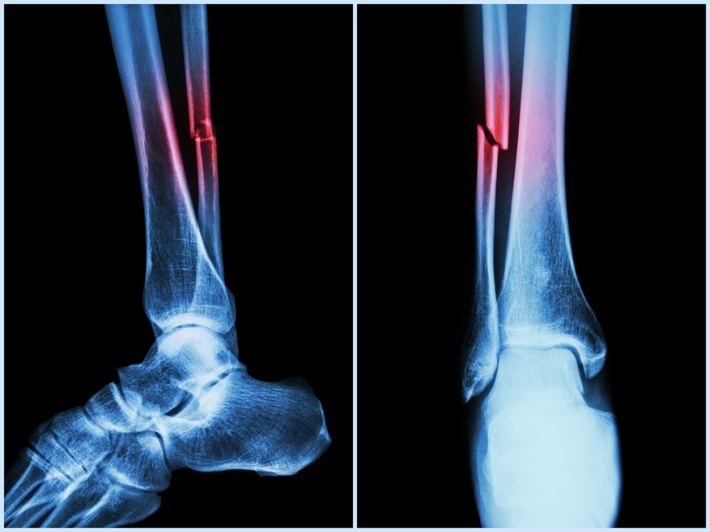 Frattura Scomposta Tibia E Perone Risarcimento Bone Fracture Injury Lawyers Topeka | Irigonegaray, Turney, & Revenaugh LLP